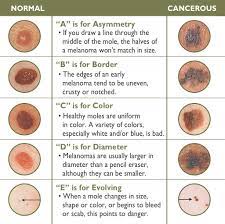 Melanoma is a form of skin cancer, which develops from cells called melanocytes. Healthy Viewpoints Early Signs Of Skin Cancer