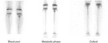 Image result for Osteomyelitis Bone Scan