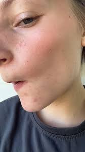 Hey ladies! Wondering if someone can tell me what these little red bumps  are