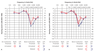 Audiometry Screening And Interpretation American Family