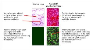 Glomerular basement membrane female carrier alport syndrome progressive hearing loss glomerular basement membrane thickness. Anti Gbm Disease Unc Kidney Center