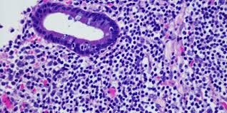 Download lymphoma images and photos. Follicular Lymphoma Targeting The Tumor Microenvironment May Be A Key Development