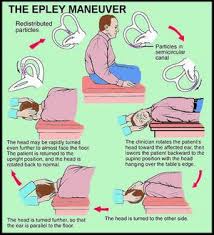 Benign Paroxysmal Positional Vertigo Wikem Vertigo Treatment Epley Maneuver Vertigo Exercises