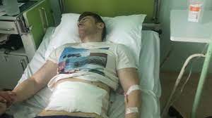 Hernia de disc de ce persistă durerile după operaţie. M Am Operat De Hernie InghinalÄƒ DupÄƒ Cat Timp Pot Merge La SalÄƒ Youtube