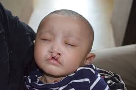 Rotaplast Missions: 2014 Sylhet, Bangladesh