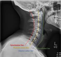 Here's what to expect with this painless procedure and why your dentist may recommend it. Cervical Spine Imaging In Trauma