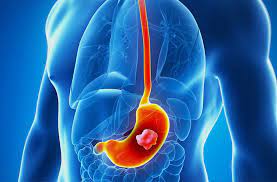 Stomach cancer is usually not found at an early stage because it often does not cause specific symptoms. What Is The Symptoms Of Stomach Cancer In Hindi
