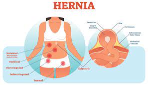 Inguinal hernia surgery is also called herniorrhaphy or hernioplasty. Simplify Hernia Repair Coding Aapc Knowledge Center