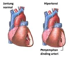 Lantas apakah penyakit lupus bisa disembuhkan? Jenis Penyakit Jantung Yang Wajib Kamu Ketahui Antvklik