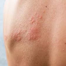 Image result for shingles