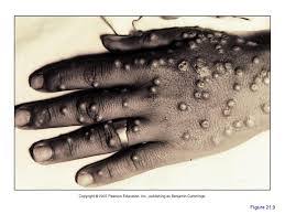 Monkeypox virus is an orthopoxvirus that causes a disease with symptoms similar, but less severe, to smallpox. Monkeypox Canada Pdf Ppt Case Reports Symptoms Treatment