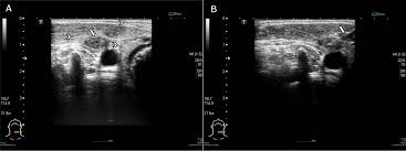 The person operating the ultrasound will sweep, or fan, the probe back and forth to look at different areas in 90 degree angle images. Plos One The Effect Of Radiotherapy On Ultrasound Guided Fine Needle Aspiration Biopsy And The Ultrasound Characteristics Of Neck Lymph Nodes In Oral Cancer Patients After Primary Treatment