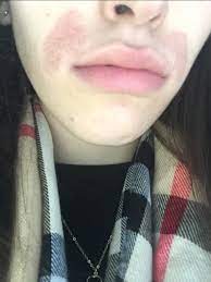 Buy your hair expulsion cream correspondingly like because numerous hair expulsion creams are designed for certain hair types. Chemical Burn On My Face From Veet Glow Community