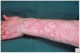 Livedo Reticularis Netting Skin Problems With Lupus Hughes Livedo Reticularis Fibromyalgia Rash Autoimmune Disease Symptoms