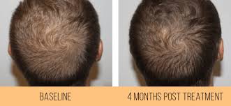 Healthy hair starts with a healthy scalp. Scalp Health Hydrafacial Keravive Rejuva Medi Spa