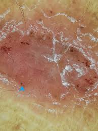 Image result for Auspitz Sign