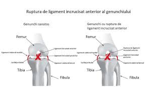 O rasucire brusca sau niste genuflexiuni. Ruptura Ligament Incrucisat Anterior Lia Cauze Tratament Dr Codorean