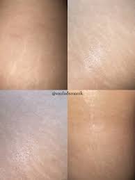 Masih GADIS tp PUNYA banyak STRETCH MARK!😔 | Galeri diposting oleh Vaula  Manik | Lemon8