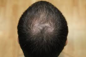 Jun 21, 2021 · menderita kanker tertentu, seperti kanker usus besar. Alopecia Kebotakan Gejala Penyebab Pengobatan Dll