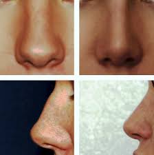 Bulbous Nose Rhinoplasty Before And After Pictures Rhinoplasty Before And After Bulbous Nose Nose Surgery