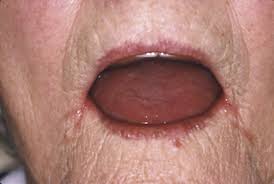 Image result for Angular Stomatitis