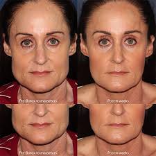Sheffield, md says in essence, botox functions by permanently connecting to receptors that transmit nerve signals for the muscles to contract. Cosmetic Laser Dermatology Botox To The Masseters By Dr Groff Botox Is Often Injected Into The Jaw Masseter Muscles For One Of Two Reasons The First And Most Common