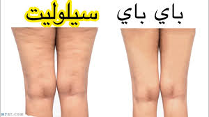اسباب السيلوليت في المؤخرة والافخاذ