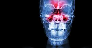 Image result for Sinus CT