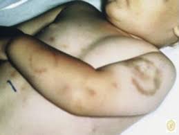 Image result for Human Bite