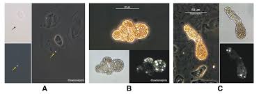 Image result for Isolated Proteinuria