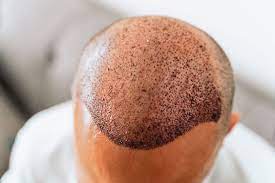 How Much Does a Hair Transplant Cost in Winnipeg? A Comprehensive Guide to  Pricing