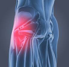 Pain is felt on the side of the hip and the outside of the upper thigh. What Causes Hip Pain Dr Scholl S