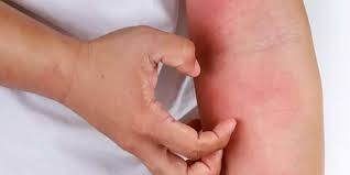 Apakah bersentuhan kulit dengan penderita akan menularkan hiv/aids. Ruam Dan Kondisi Kulit Seperti Ini Yang Jadi Gejala Seseorang Terjangkit Hiv Semua Halaman Intisari