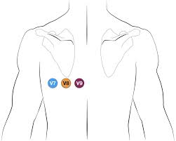 Ecg Lead Positioning Litfl Medical Blog Ecg Library Basics