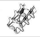 How and When to Use Hooks to Improve Deformity Correction ...