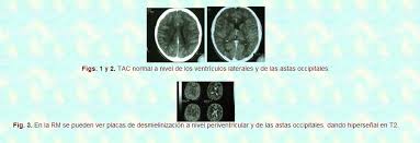 El tac craneal fue también informado como normal. Esclerosis Multiple Infantil Caso Clinico Guia De La Discapacidad