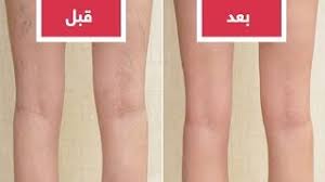 الحصوات صغرة الحجم أكثر خطورة من تلك كبيرة الحجم حيث ان الحصوات الصغيرة يمكنها ان تنزلق بسهولة لتسد القناة المرارية و يحدث المضاعفات المذكورة اعلاه. Ù‡Ù„ ØªØ¹Ø§Ù†ÙŠ Ù…Ù† Ø§Ù„Ø¯ÙˆØ§Ù„ÙŠ ØªØ¹Ø±Ù Ø¥Ù„Ù‰ Ø£Ø³Ø¨Ø§Ø¨Ù‡Ø§ ÙˆØ·Ø±Ù‚ Ø¹Ù„Ø§Ø¬Ù‡Ø§ Youtube