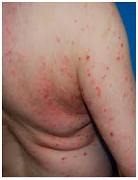 Image result for Papular urticaria