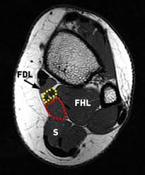 Findings on conventional arthrography and mr imaging. Accessory Muscles Of The Ankle Radsource