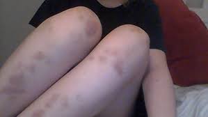 Warum Habe Ich So Viele Blaue Flecken D Beine Bluterguss Blaue Flecken