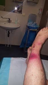 Recessed lighting installation necrotizing fasciitis causes swelling. Necrotizing Fasciitis Flesh Eating Disease Physiopedia