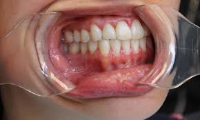 Image result for dental cancer