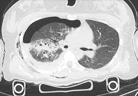 Image result for Pulmonary Contusion