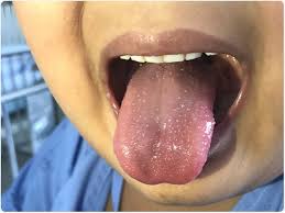 Image result for Scarlet Fever