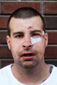 The Story Behind Jeremy Menduni's Face Injury