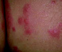 See what else may be causing your itch and what can bring relief. 8 Management Of Allergy Rashes And Itching Emergency Medicine Journal