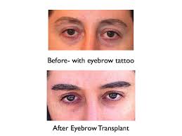We perform eyebrow transplantation for both men and women. Eyebrow Transplants For Men Marc Dauer Md Hair Transplant Doctor Los Angeles