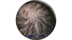 Finasteride also works best at treating hair loss where there is a receding hairline and thinning — in areas of complete hair loss, it will not work as well. How Long Does Finasteride Take To Work