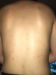 You might also want to pin it up so that if you leave it in for a bit before washing it out so it's not resting on your back/shoulder. Acne I Ve Had Bacne For 11 Years Would Love Advice Recommendations For Clearing It Up Skincareaddiction