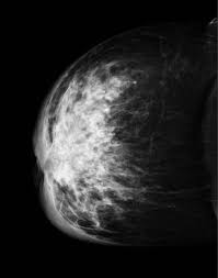 Interestingly, the signs and symptoms of ibc are quite common. Inflammatory Breast Carcinoma Radiology Case Radiopaedia Org
